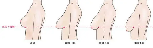 女性"胸下垂"的真正原因不是出在哺乳期,而是在孕期!