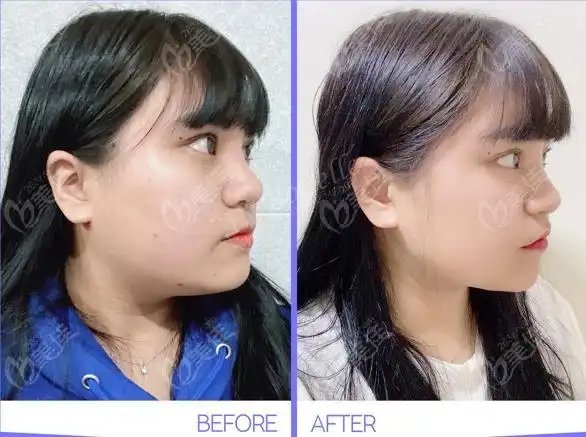 面部吸脂后大小脸一般能恢复,而且可以通过这些方法来改善大小脸