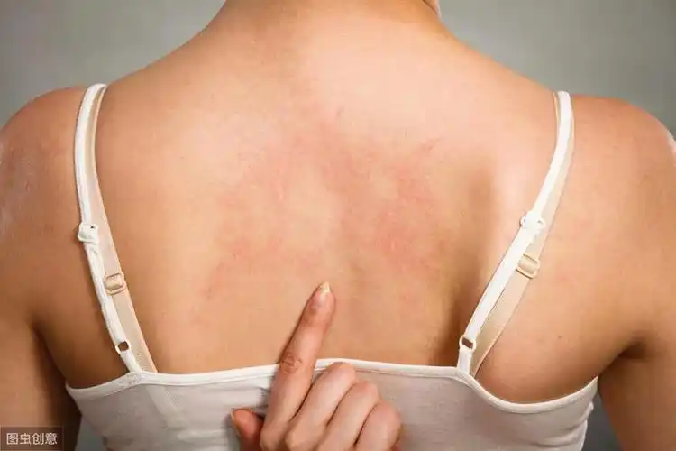 干性湿疹图片(湿疹怎么区分干性和湿性) - 乐宝宝贝