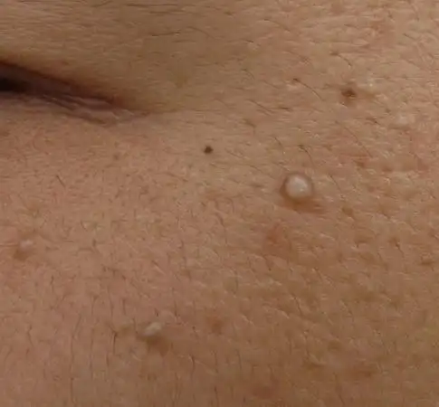 面部小疙瘩,发现有二年,生长缓慢