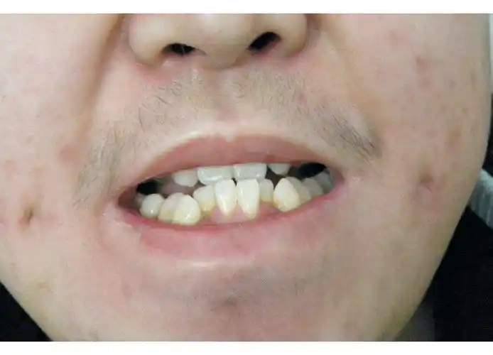 矫正牙齿对脸型的改变