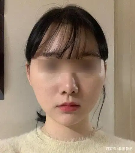 脸大脸宽别怪下颌角,妹子做颧骨效果同样惊艳!