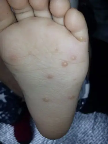 脚上起了好多水泡.手上也有几个.注意嘴上没有.是怎么回事啊?