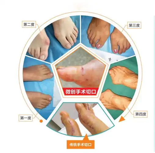 合肥经开外科医院"微创矫正术"是基于传统拇外翻微创手术基础上的全新