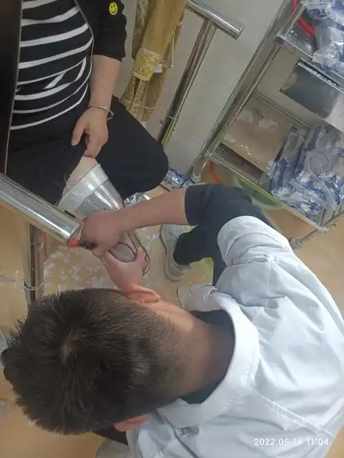 康复休养一个月后开始制作接受腔了