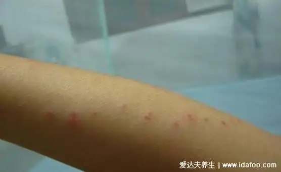 跳蚤咬的红疙瘩图片,呈直线形或三角形排列的疙瘩(附处理法)