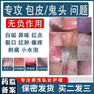 龟头炎专用药膏鬼头霉菌念珠菌软膏包皮消炎男士红点裂口特效治疗