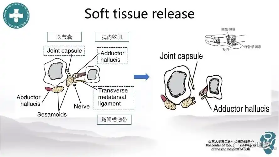 scarf截骨术治疗拇外翻的基本原理
