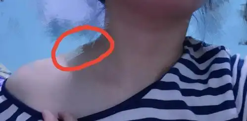 周六野斜方肌一个月后我才发现变成了这样