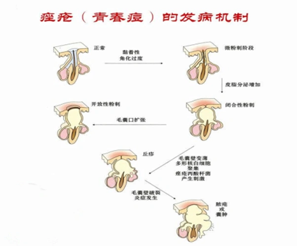 帮你了解毛囊炎
