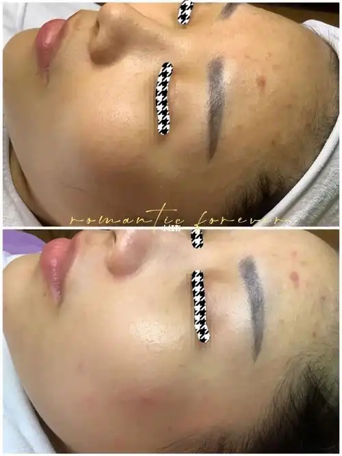 一次祛痘加补水的前后对比