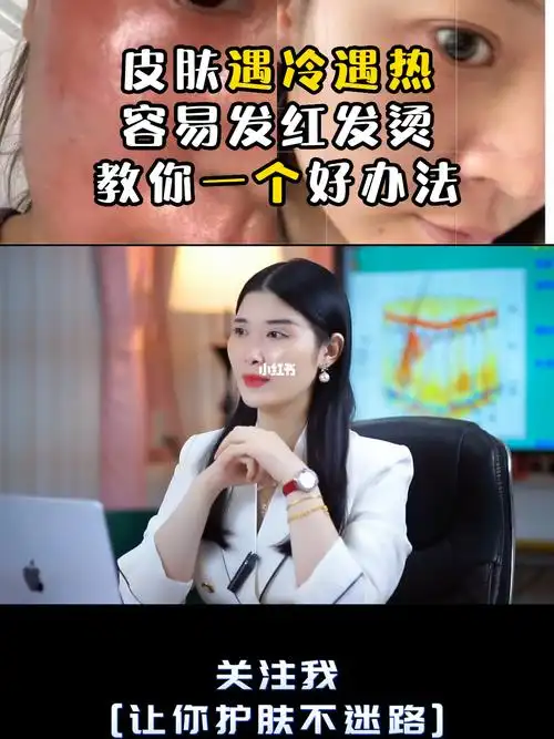 皮肤遇冷遇热容易发红发烫