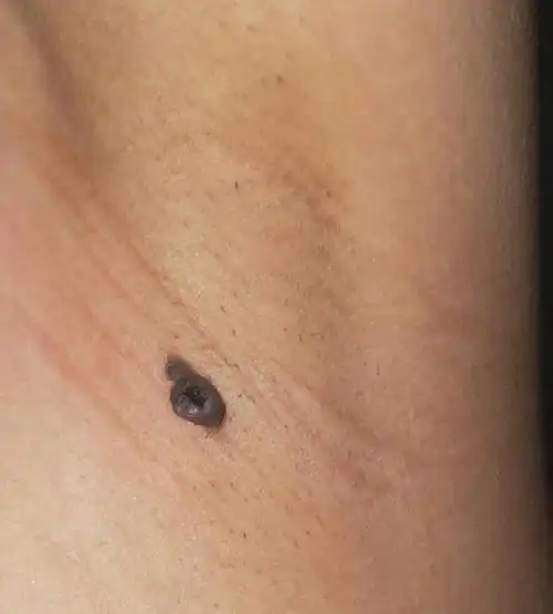 星期二的时候我去医美做腋下脱毛.