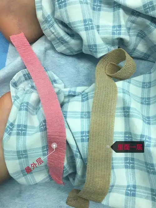 包皮吻合器手术后拆绷带事项提醒 (原创)