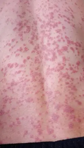 艾滋病初期皮肤症状,我们的皮肤怎么了?