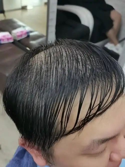 男士发量稀少m型发际线看过来