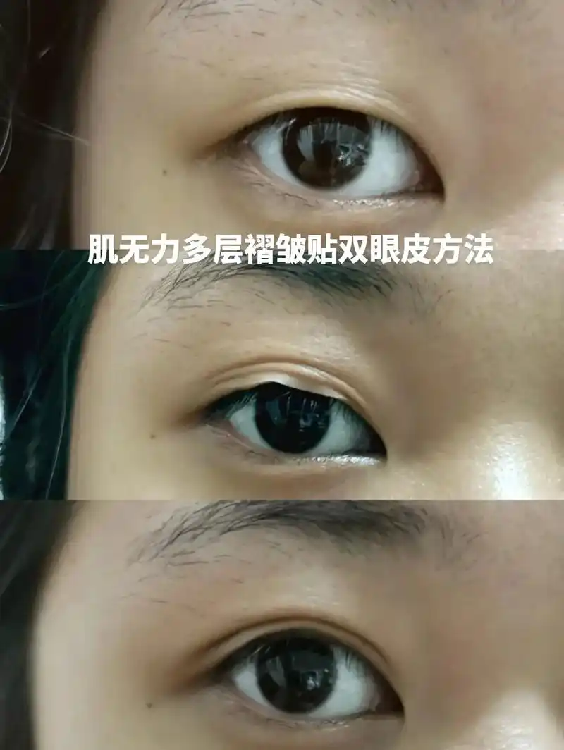 姐妹们,我悟了!眼皮肌无力松弛的快这样贴试试#双眼皮 #肿眼 - 抖音