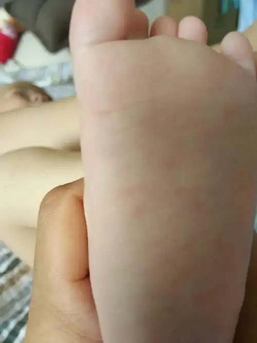 宝宝身上有红豆豆,发烧两天后,就有了,并且垃稀,有咳嗽,是手足口病吗?