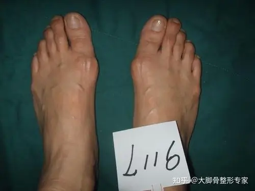 哪些大脚骨会快速发展拇外翻