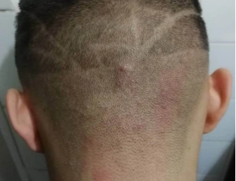 后脑勺长痘痘,后脑勺肯定是头部,其实整个头部甚至其他有毛发的部位都