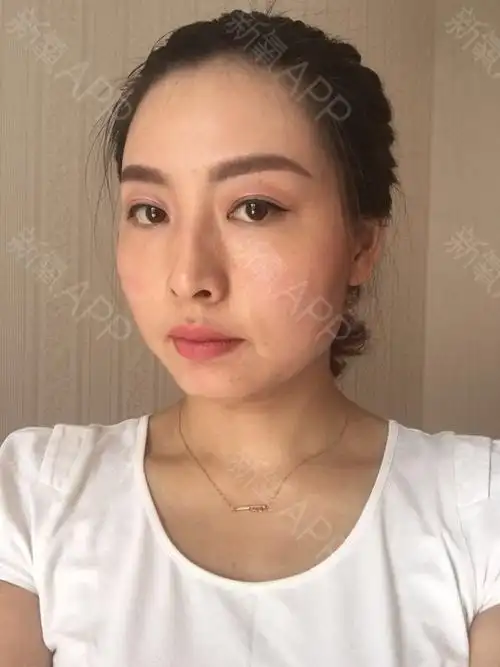 武汉自体脂肪全脸填充好不好_效果图_你难过什么自体脂肪全脸填充术后