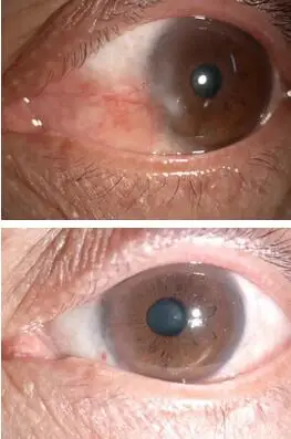 姚颖医生为文先生做了详细检查后,制定了左眼的翼状胬肉切除术,联合