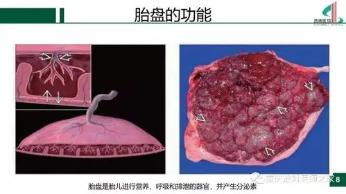 凶险性前置胎盘:影响,病理与临床