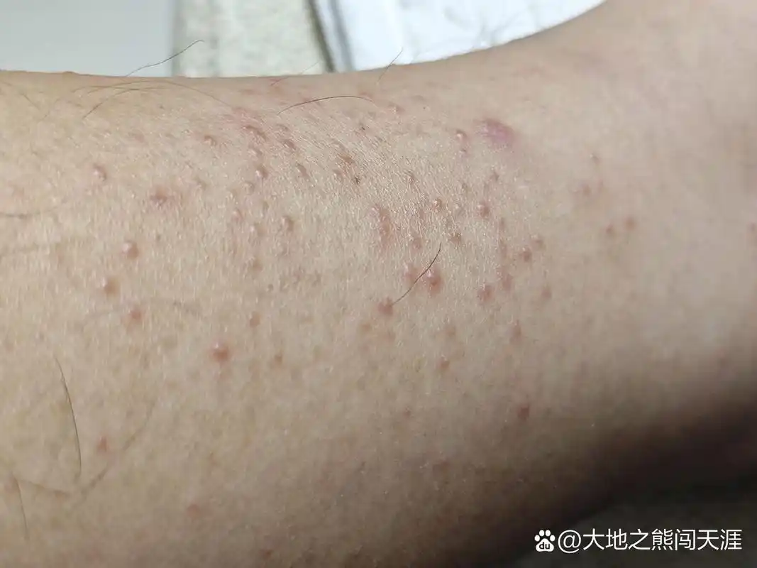 小腿内侧  有点痒  一挠更痒   是湿疹还是什么?怎么治疗