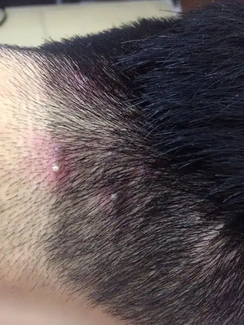 头皮老长这东西,像痘痘,很痛,这是为什么?怎么解决?