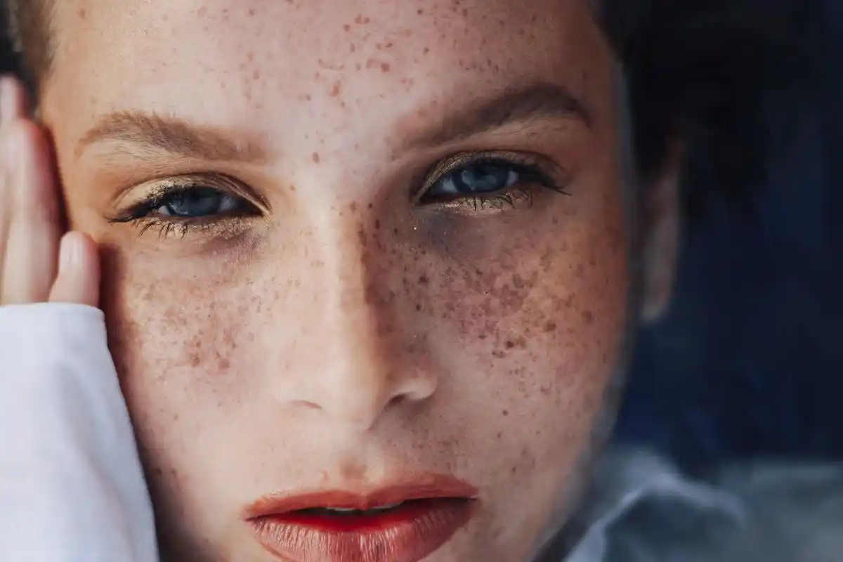 雀斑成为时尚女性的烦恼如何简单有效的摆脱脸上的雀斑