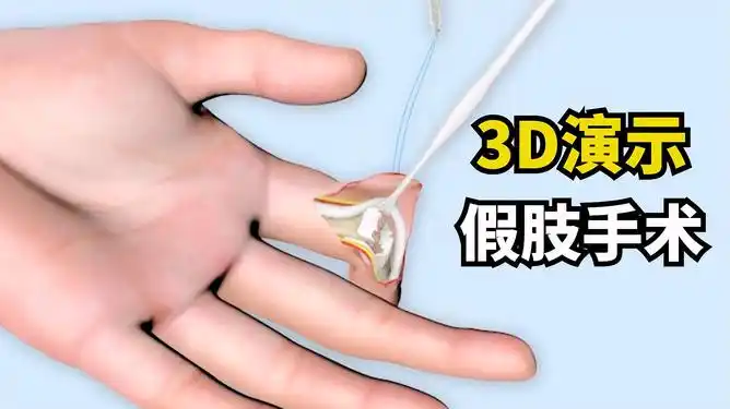 医生操刀安装假肢手指再次重获新生看完手指隐隐作痛