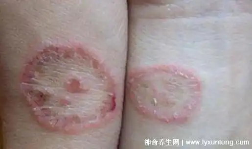 体癣图片初期症状图片圆形红斑边缘一圈红肿脱屑和湿疹区分