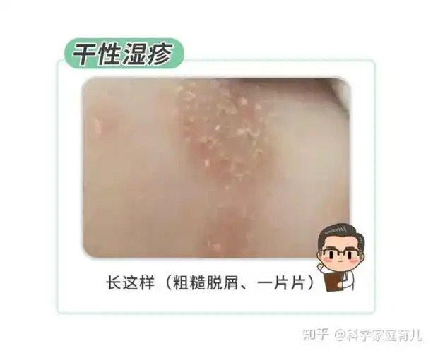 以病因分类,秋冬最常见的干性湿疹(又称乏脂性湿疹)更是如此,病因就是