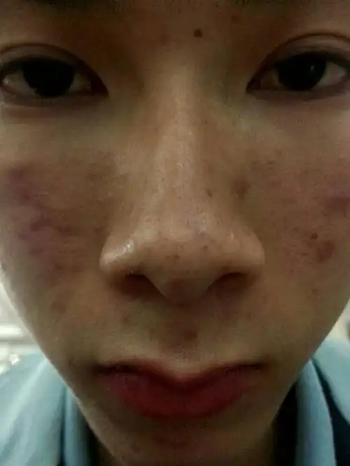 毛孔粗大,鼻子有黑头,鼻子有油是什么皮肤