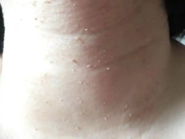 丝状疣是瘊子疾病当中的一种,是由人类乳头瘤病毒所引起的,发生于皮肤