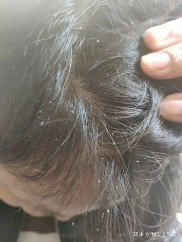 自从不小心头皮患上脂溢性皮炎开始,本人就特别注重头发的保养,平时也