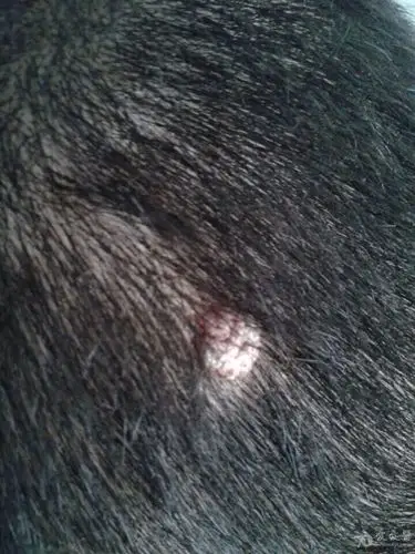 头皮上长一个疙瘩这是什么病怎么治疗