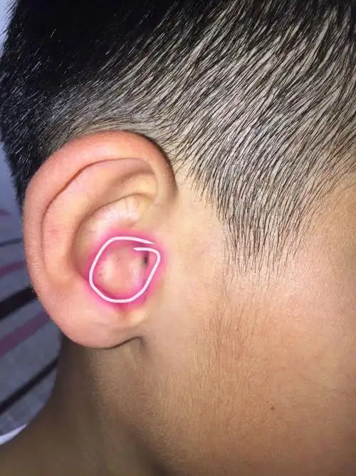 问答 问答首页  满意回答 考虑孩子是急性耳软骨膜炎的可能比较大,以