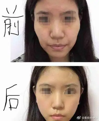 01/脂肪填充案例67676767这个术前肉眼可见的太阳穴凹陷导致