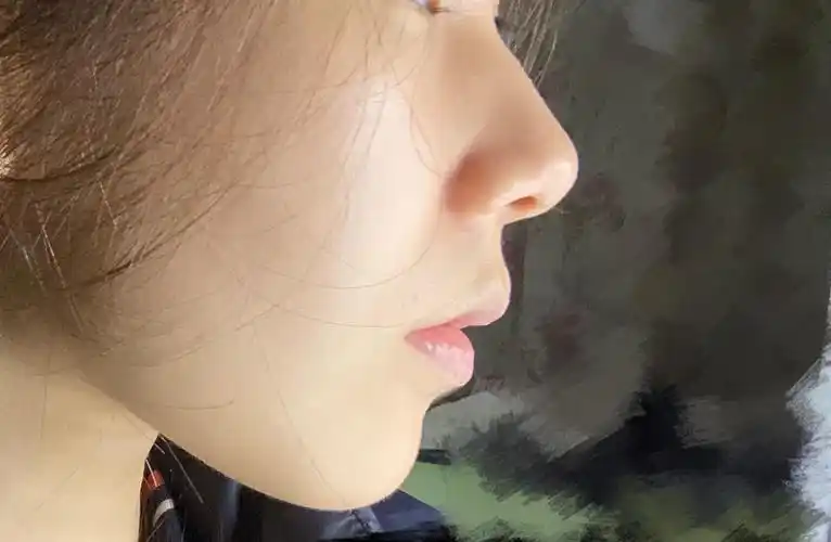 请问深覆合导致的嘴凸和法令纹会随着年龄增长越来越严重吗