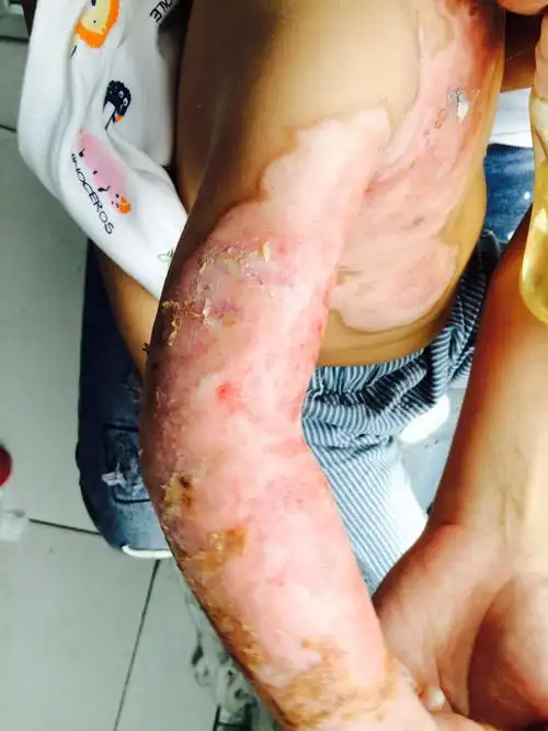 1岁10个月小儿4月23日晚8点左右开水烫伤全身多处面积达15%,2度-3度