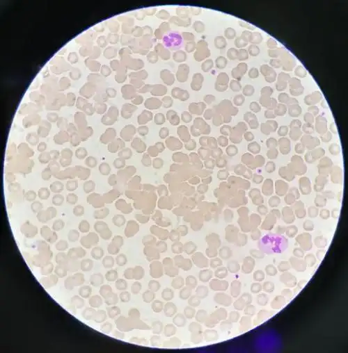 血涂片镜检:可见红细胞凝集.