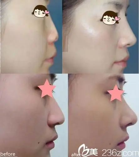 呼市吴老贵假体隆鼻对比图
