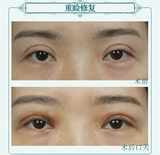 12mm宽平行双眼皮修复开扇形术后17天眼睛变化