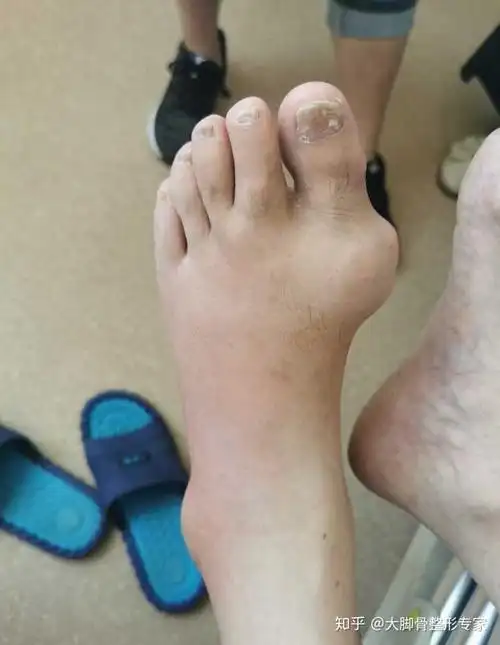 拇外翻和痛风怎么区别?