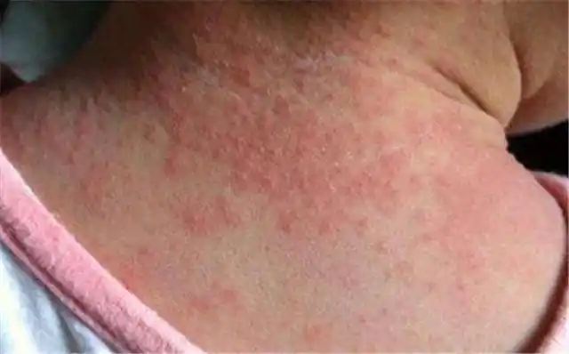 宝宝一热就长湿疹,反反复复有哪些方法可以缓解?看育儿专家理解