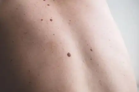 一个男人背部裸露皮肤的特写,上面有散落的痣和雀斑.照片