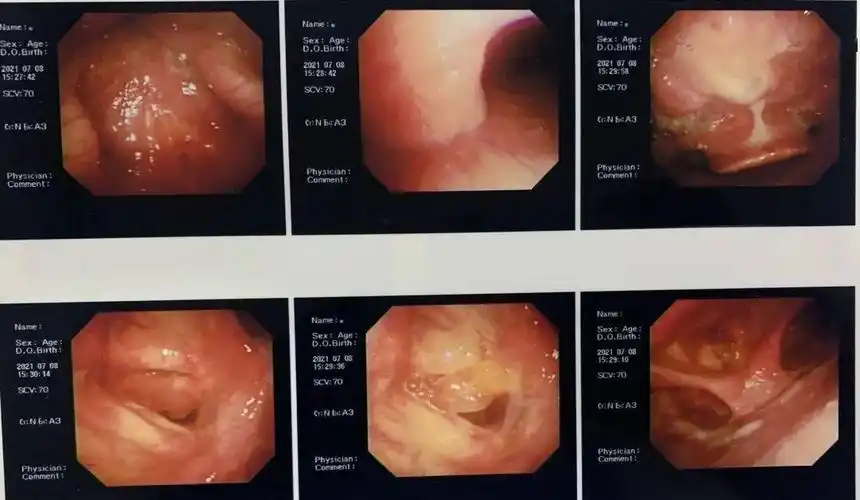 医生在电子喉镜下所见:喉部粘膜慢性充血,悬雍垂见淡红色乳头状新生物