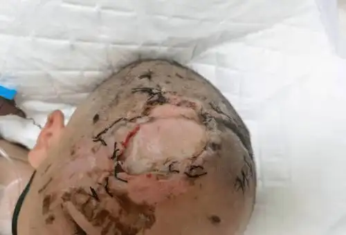 icu主任,主任医师徐兰娟提醒大家近两个月来仅icu收治的儿童坠落伤