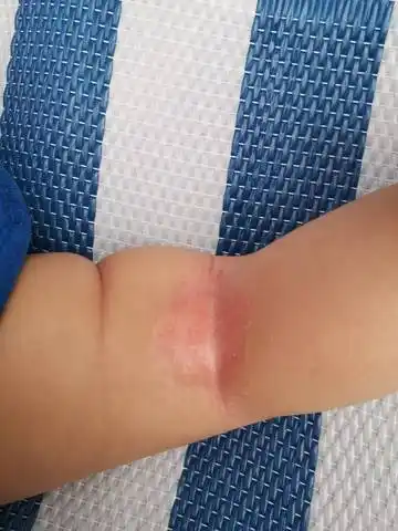 快4个月的宝宝～身体皮肤褶皱地方有～我们这里温度23-25度左右～如何